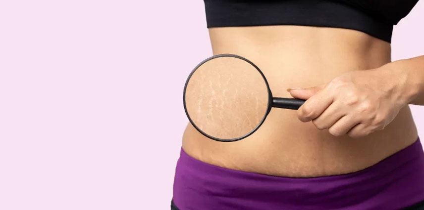 Stretch Mark Reduction Treatment in Kandivali East and West - Dr. Pinky Mehta