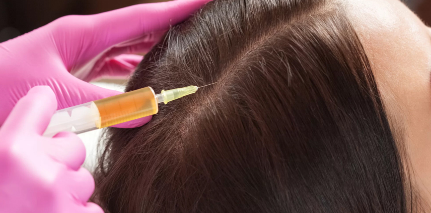PRP and GFC Hair Treatment in Kandivali East and West - Dr. Pinky Mehta